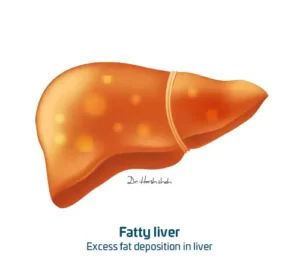 fatty liver