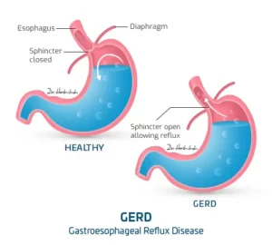 gastroesophageal reflux disease m821as