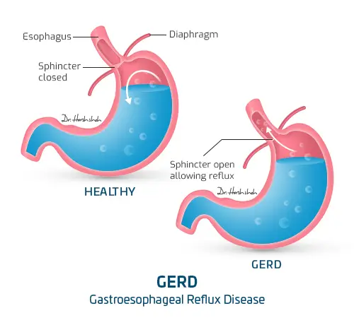 gastroesophageal reflux disease m821as