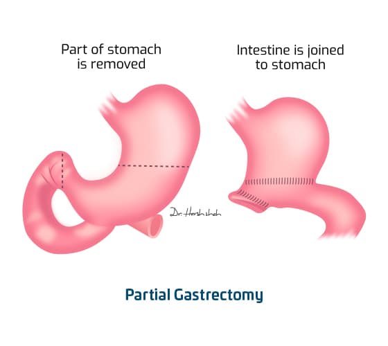 no 1 stomach cancer hospital in ahmedabad
