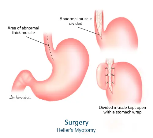 top achalasia cardia doctor in ahmedabad