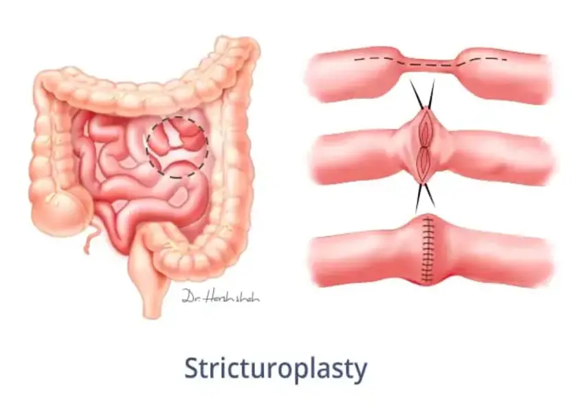top crohn s disease hospital in ahmedabad 1