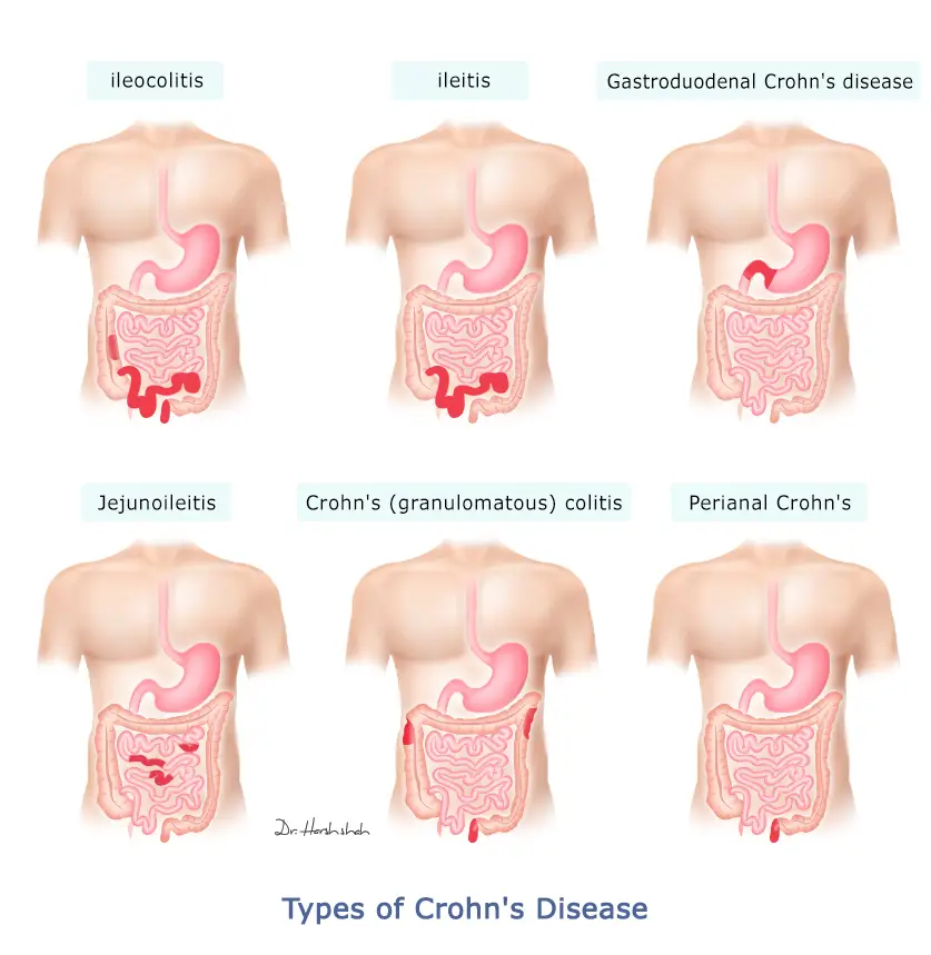 types of crohn s disease