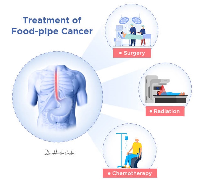 treatment of esophageal cancer
