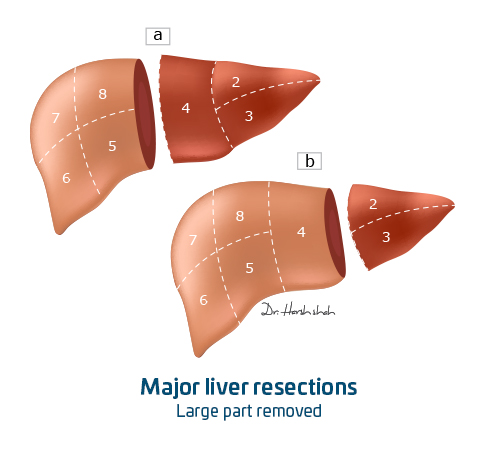 Liver cancer treatment with Major-liver-resections in Ahmedabad