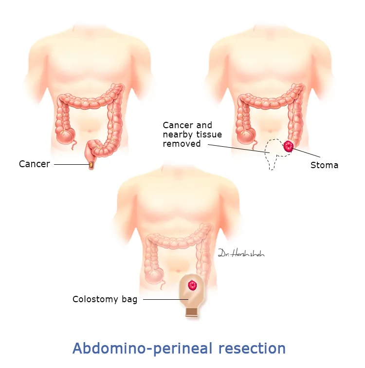 Abdomino-perineal-resection