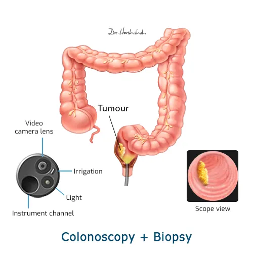 Colonoscopy-+-Biopsy