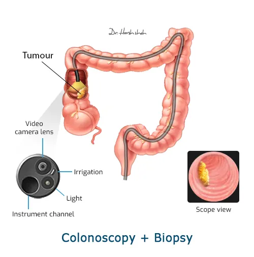 Colonoscopy-Biopsy