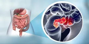 HIPEC for Colorectal cancer