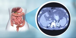 HIPEC for Pseudomyxoma peritonei