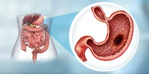 HIPEC for gastric cancer
