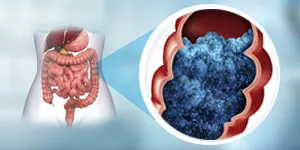 HIPEC for pancreatic cancer