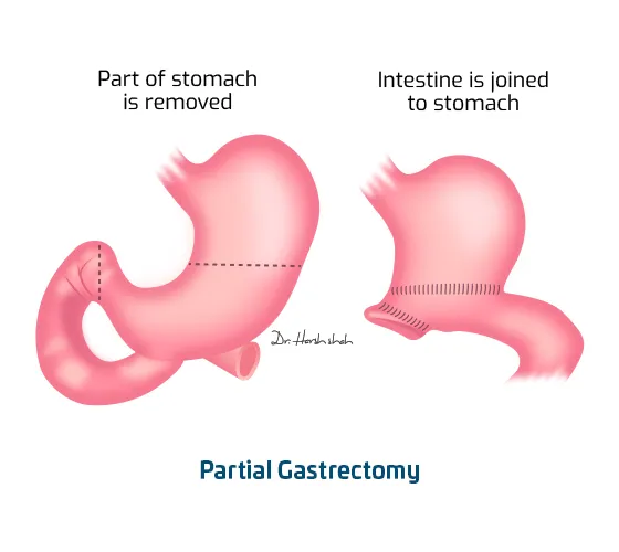 Partial Gastrectomy
