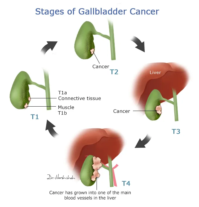 Dr. Harsh Shah - Best Gallbladder cancer doctor in Ahmedabad - Dr ...