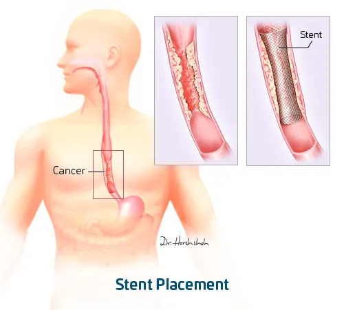 Stenting - Stent Placing for esophageal cancer treatment