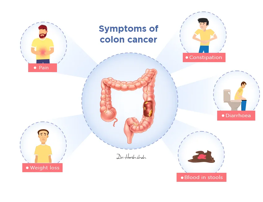 Symptoms-of-colon-cancer