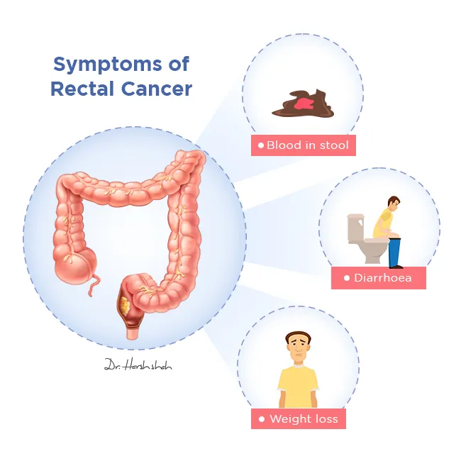 Symptoms-of-rectal-cancer