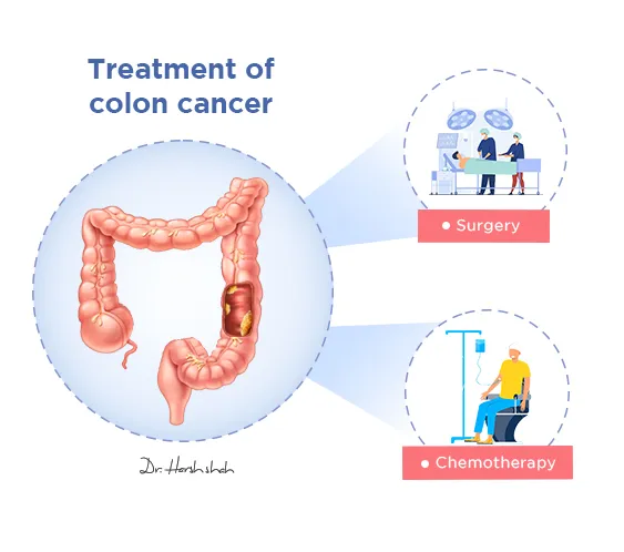 Treatment-of-colon-cancer