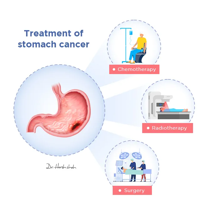 Treatment-of-stomach-cancer