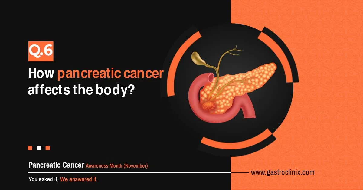 How pancreatic cancer affects the body