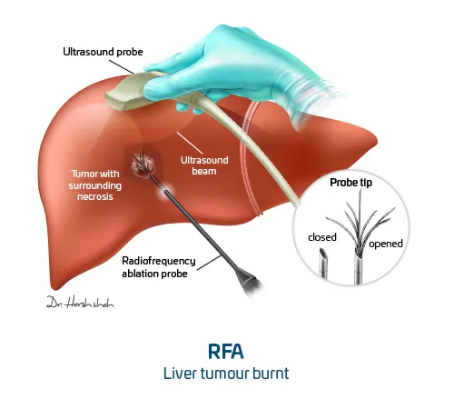 radiofrequency ablation - RFA