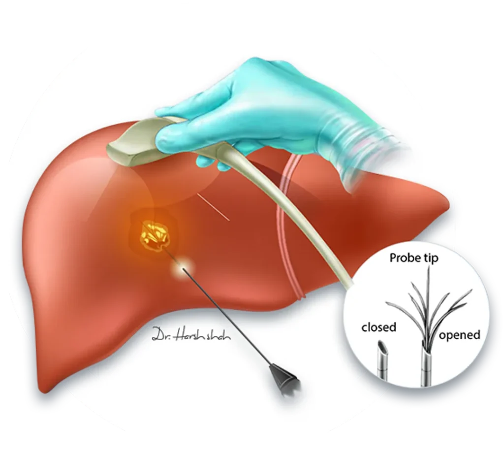 Radiofrequency Ablation for Liver Tumours (RFA)