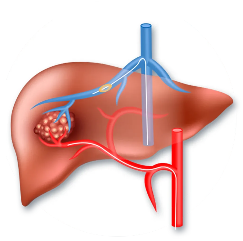 Transarterial Chemoembolization (TACE) for Liver Tumors