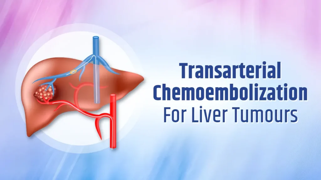 Transarterial Chemoembolization - TACE - for liver tumors