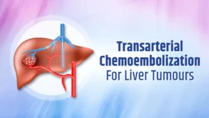 Transarterial Chemoembolization - TACE - for liver tumors
