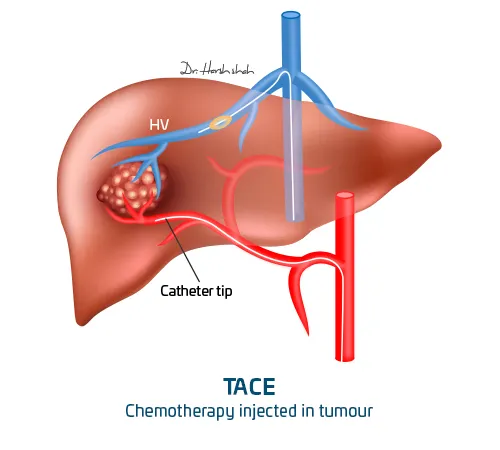 transarterial chemoembolization (TACE)