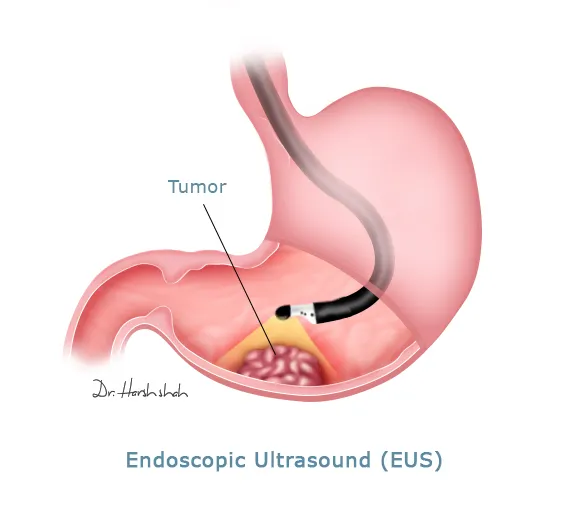 EUS - Stomach Cancer