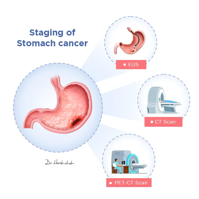 Staging of stomach cancer