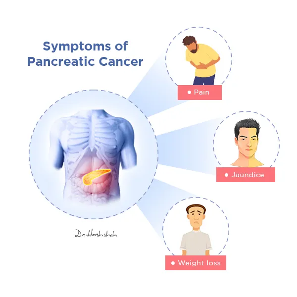 Signs and Symptoms of Pancreatic Cancer