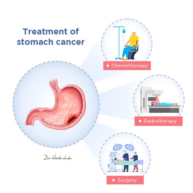 Treatment options for stomach cancer