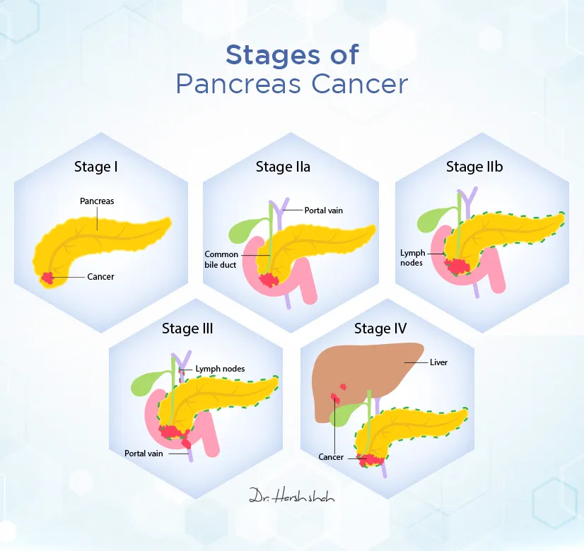 What are the stages of pancreatic cancer