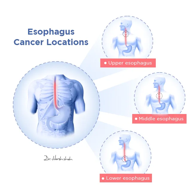 Esophagus-Cancer-Locations
