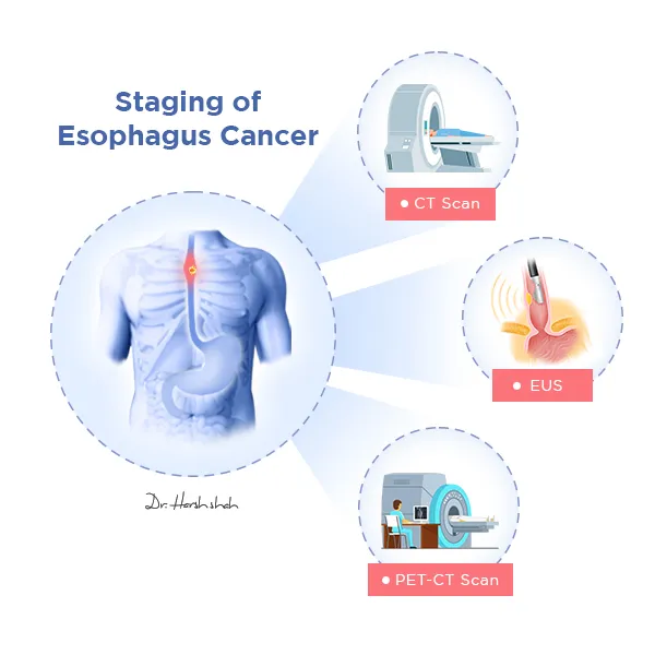 Staging-of-Esophagus-Cancer