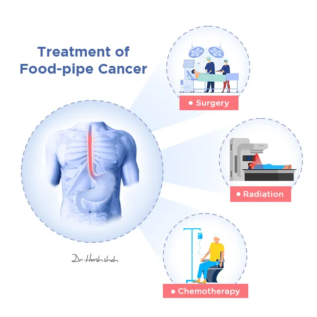 Treatment-of-Food-pipe-Cancer