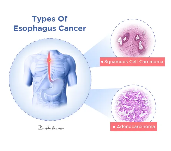 Types-Of-Esophagus-Cancer
