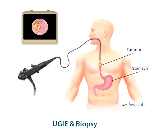 UGIE-&-Biopsy