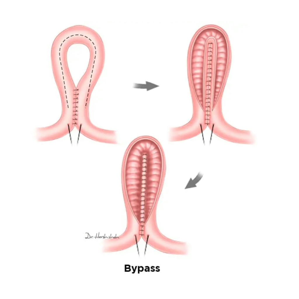 Best Bypass Gastro Surgery in Ahmedabad - Dr. Harsh Shah