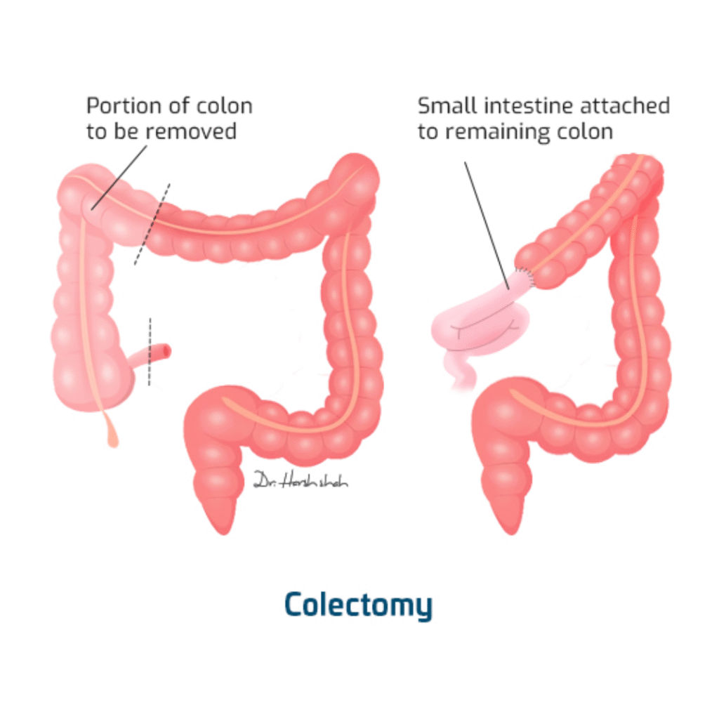 Best Colectomy Surgery in Ahmedabad Dr. Harsh Shah