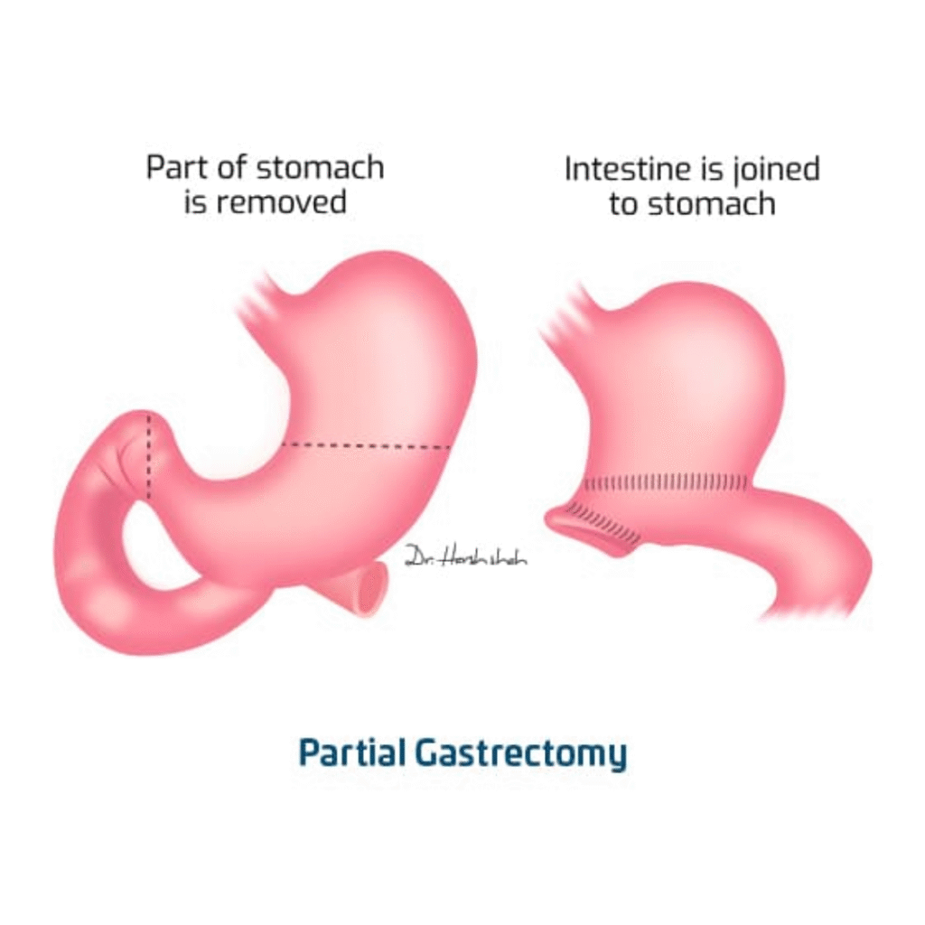 Best Partial Gastrectomy Surgery in Ahmedabad - Dr. Harsh Shah