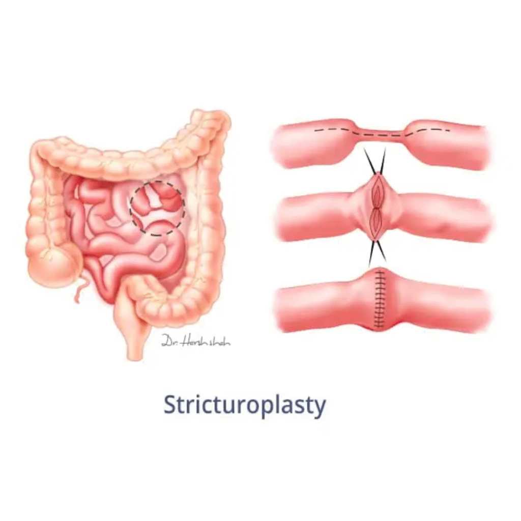 Best Stricturoplasty Surgery in Ahmedabad - Dr. Harsh Shah