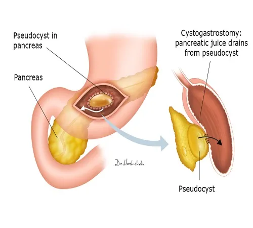 Cystogastrostomy Pancreatic Surgery in Ahmedabad