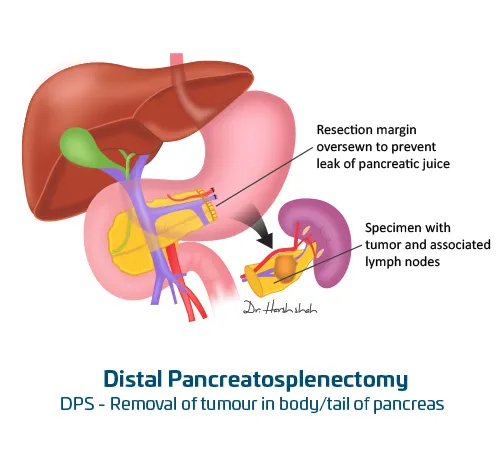 Distal-Pancreatosplenectomy - Pancreatic Surgery in Ahmedabad