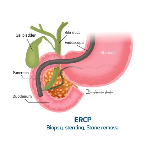 ERCP - by Dr Harsh Shah for the Pancreatic Treatment in Ahmedabad