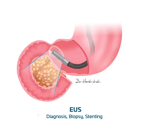 EUS - Diagnosis-biopsy and stenting - pancreatic treatment in Ahmedabad