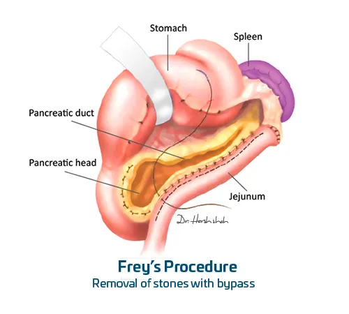 Frey’s-Procedure Pancreatic Surgery in Ahmedabad