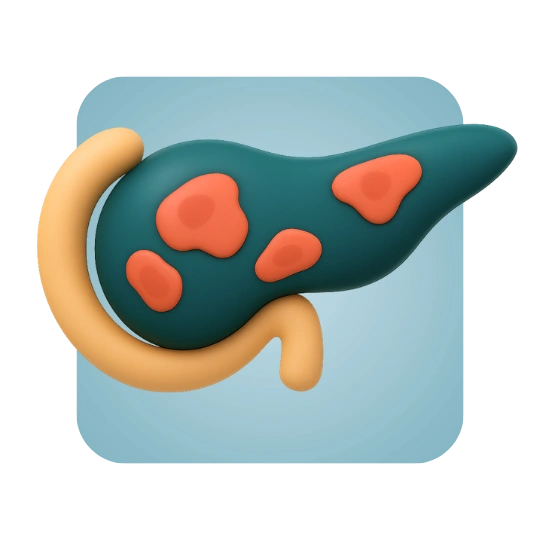 Necrotizing Pancreatitis